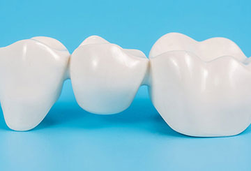 Why Should You Invest in Dental Crowns?
