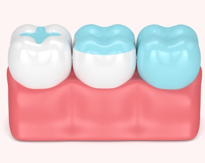 Get the Facts: Why Composite Dental Fillings Are Essential for Your Oral Health!