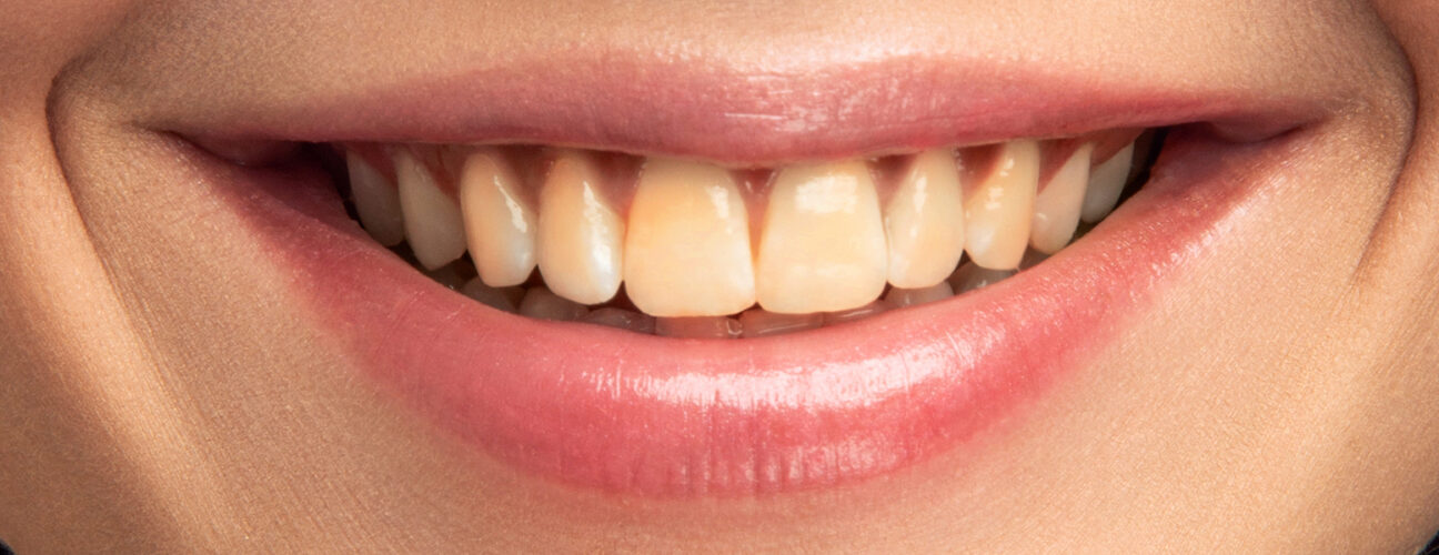 Why Do Our Teeth Turn Yellow? Even with Good Oral Hygiene