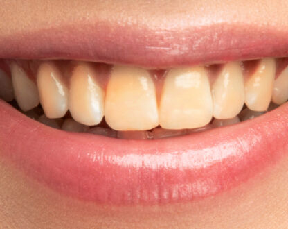Why Do Our Teeth Turn Yellow? Even with Good Oral Hygiene