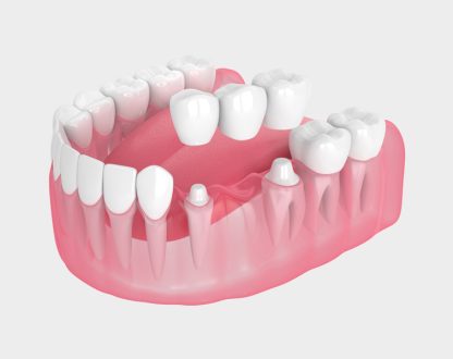 Can a Dental Bridge Prevent Teeth from Shifting?